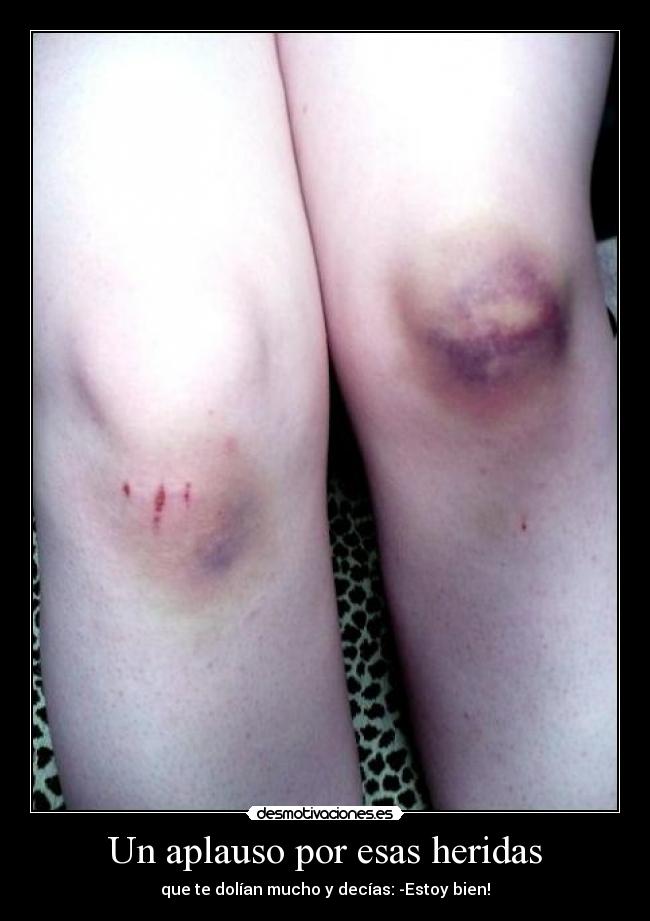 Un aplauso por esas heridas - 
