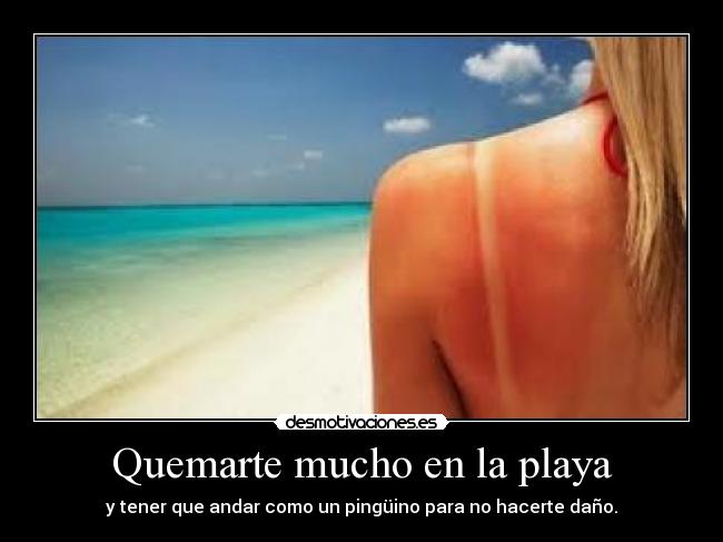 Quemarte mucho en la playa - y tener que andar como un pingüino para no hacerte daño.
