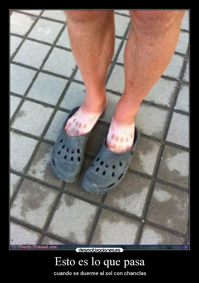 Esto es lo que pasa - cuando se duerme al sol con chanclas