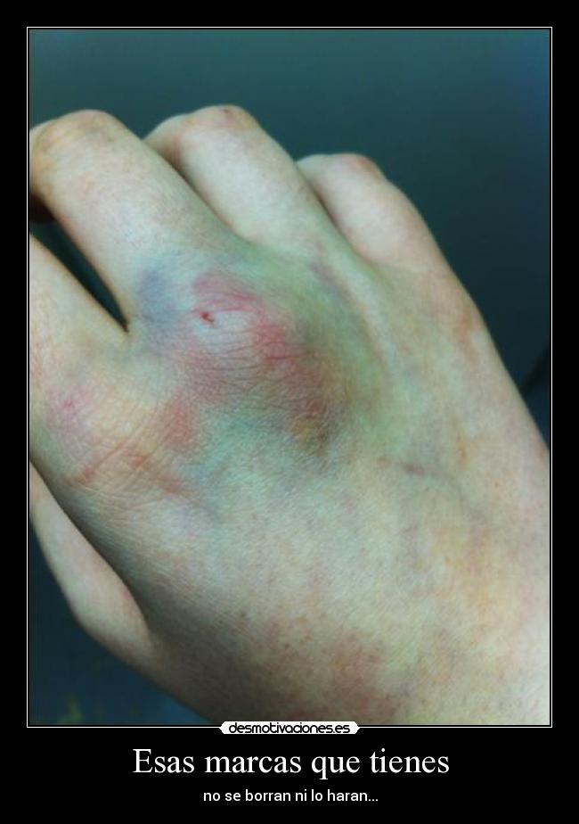 Esas marcas que tienes - no se borran ni lo haran...