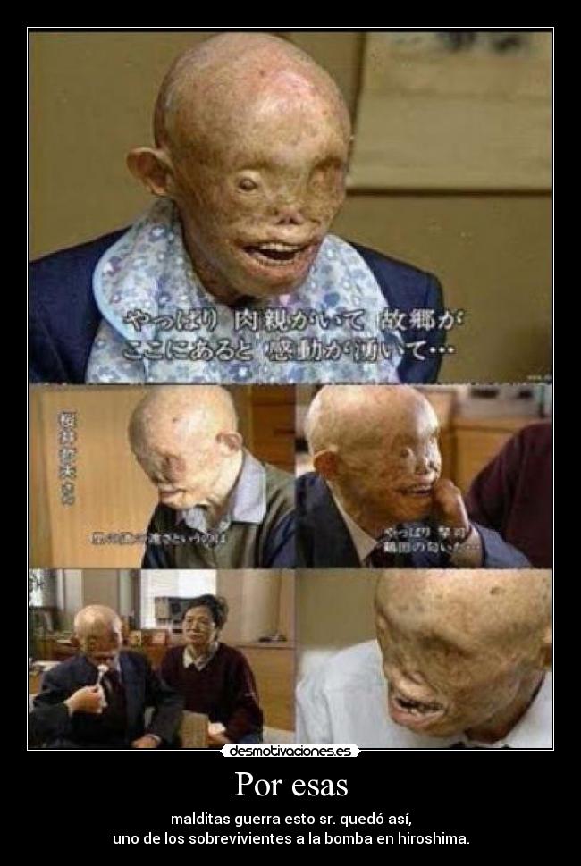 Por esas - malditas guerra esto sr. quedó así,
uno de los sobrevivientes a la bomba en hiroshima.