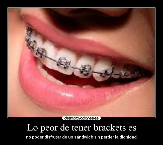 Lo peor de tener brackets es - no poder disfrutar de un sándwich sin perder la dignidad.