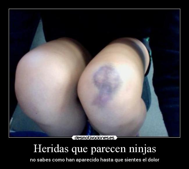 Heridas que parecen ninjas - no sabes como han aparecido hasta que sientes el dolor