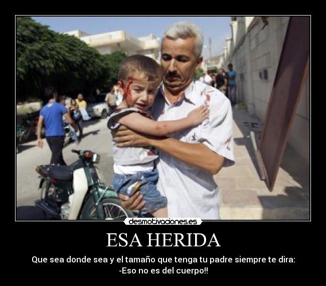 ESA HERIDA - Que sea donde sea y el tamaño que tenga tu padre siempre te dira:
-Eso no es del cuerpo!!
