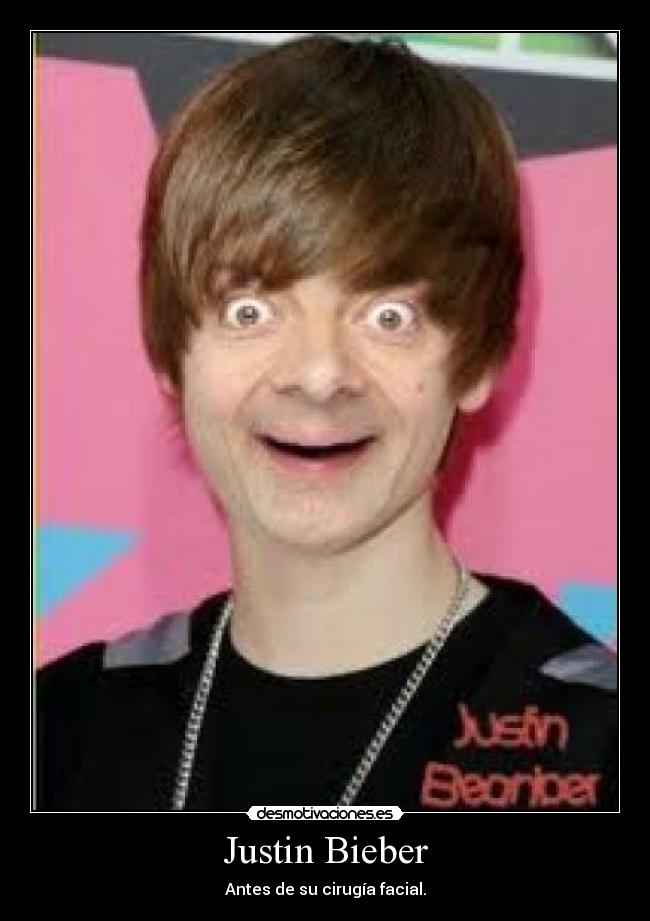 Justin Bieber - Antes de su cirugía facial.