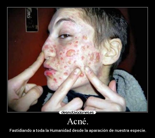 Acné. - Fastidiando a toda la Humanidad desde la aparación de nuestra especie.