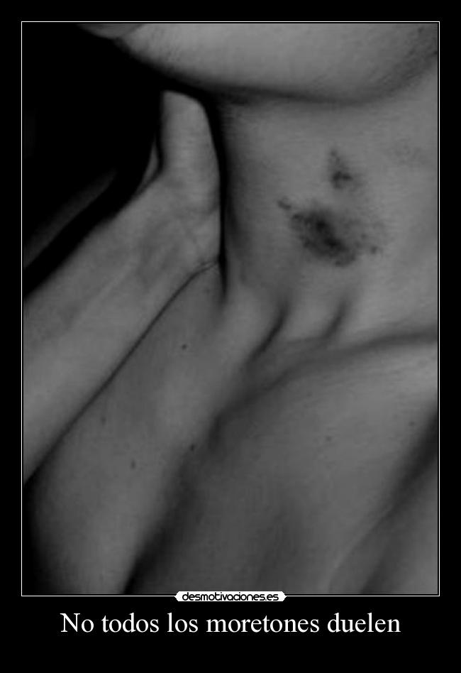 No todos los moretones duelen -