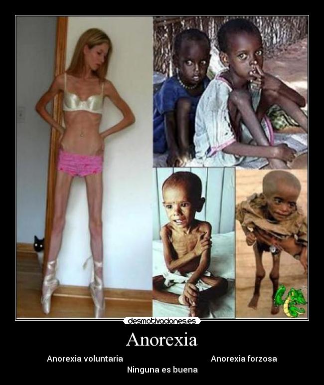 Anorexia -