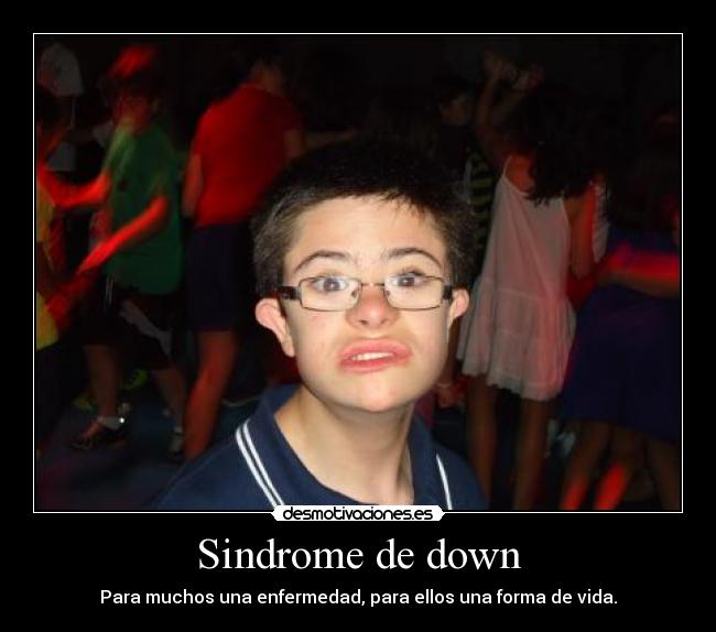 Sindrome de down -