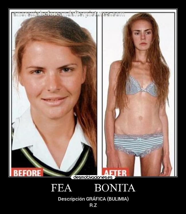 FEA        BONITA - Descripción GRÁFICA (BULIMIA)
R.Z