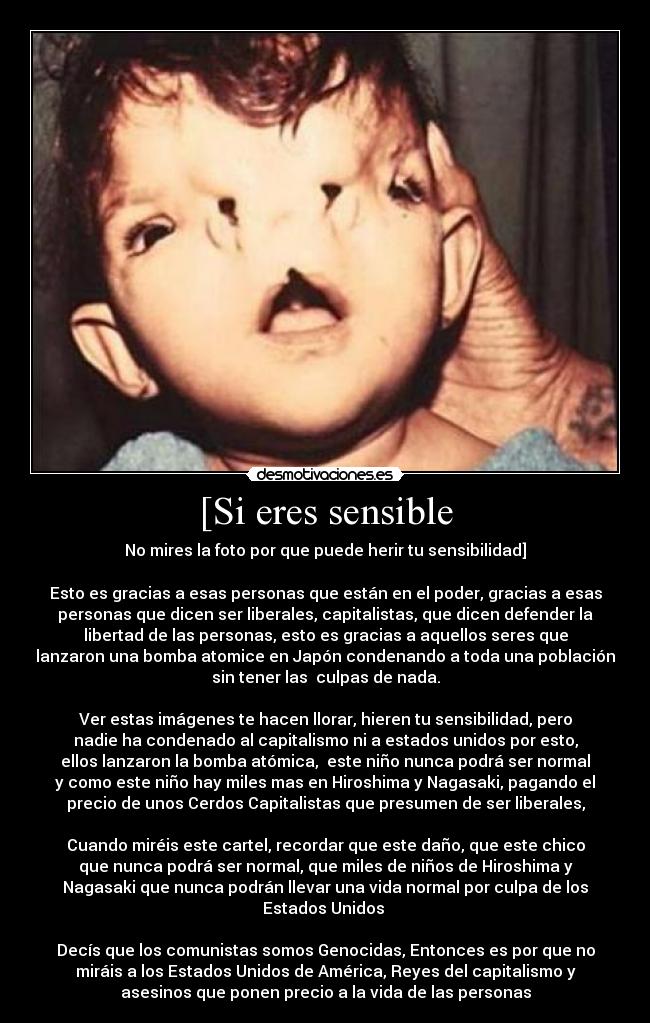 [Si eres sensible - No mires la foto por que puede herir tu sensibilidad]

Esto es gracias a esas personas que están en el poder, gracias a esas
personas que dicen ser liberales, capitalistas, que dicen defender la
libertad de las personas, esto es gracias a aquellos seres que
lanzaron una bomba atomice en Japón condenando a toda una población
sin tener las  culpas de nada.

Ver estas imágenes te hacen llorar, hieren tu sensibilidad, pero
nadie ha condenado al capitalismo ni a estados unidos por esto,
ellos lanzaron la bomba atómica,  este niño nunca podrá ser normal
y como este niño hay miles mas en Hiroshima y Nagasaki, pagando el
precio de unos Cerdos Capitalistas que presumen de ser liberales,

Cuando miréis este cartel, recordar que este daño, que este chico
que nunca podrá ser normal, que miles de niños de Hiroshima y
Nagasaki que nunca podrán llevar una vida normal por culpa de los
Estados Unidos 

Decís que los comunistas somos Genocidas, Entonces es por que no
miráis a los Estados Unidos de América, Reyes del capitalismo y
asesinos que ponen precio a la vida de las personas