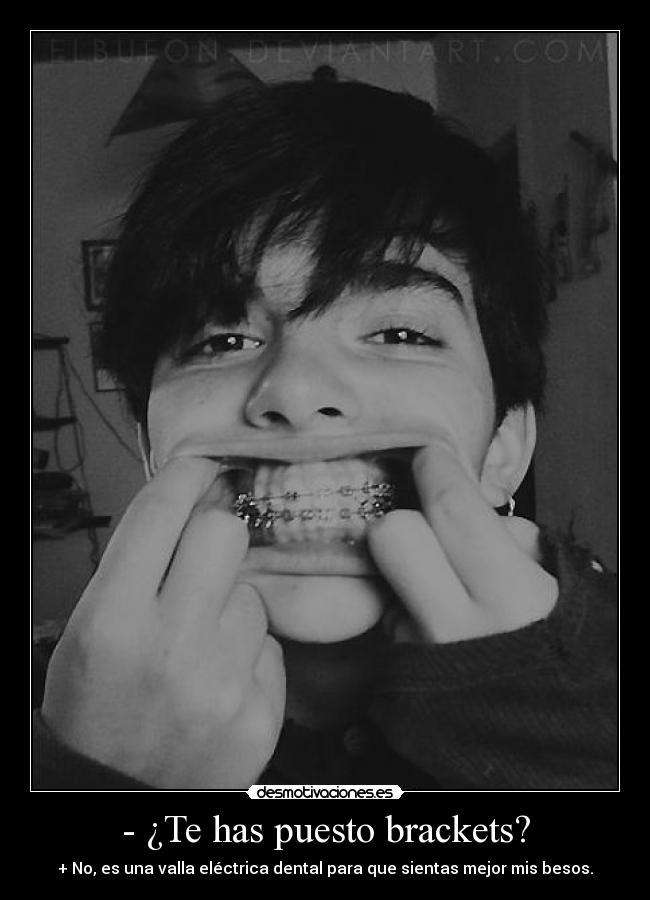 - ¿Te has puesto brackets? - 
