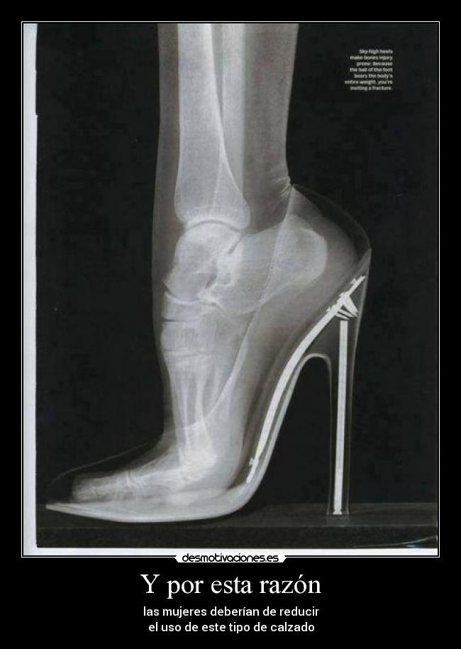 Y por esta razón - las mujeres deberían de reducir
el uso de este tipo de calzado