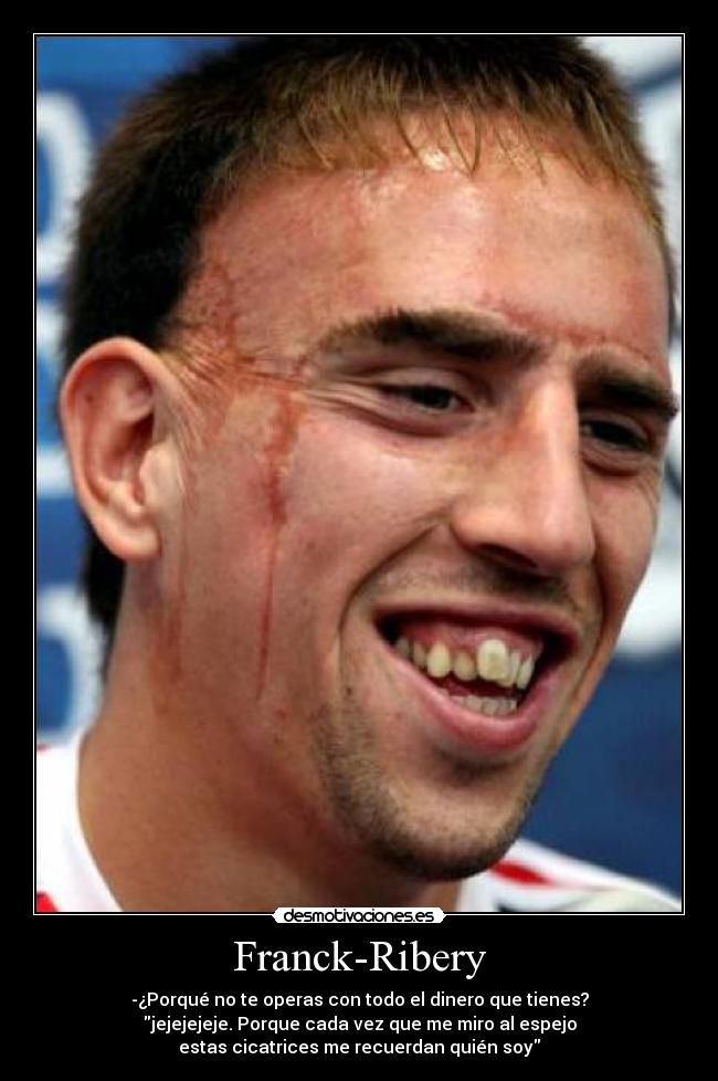 Franck-Ribery - -¿Porqué no te operas con todo el dinero que tienes?
jejejejeje. Porque cada vez que me miro al espejo
estas cicatrices me recuerdan quién soy
