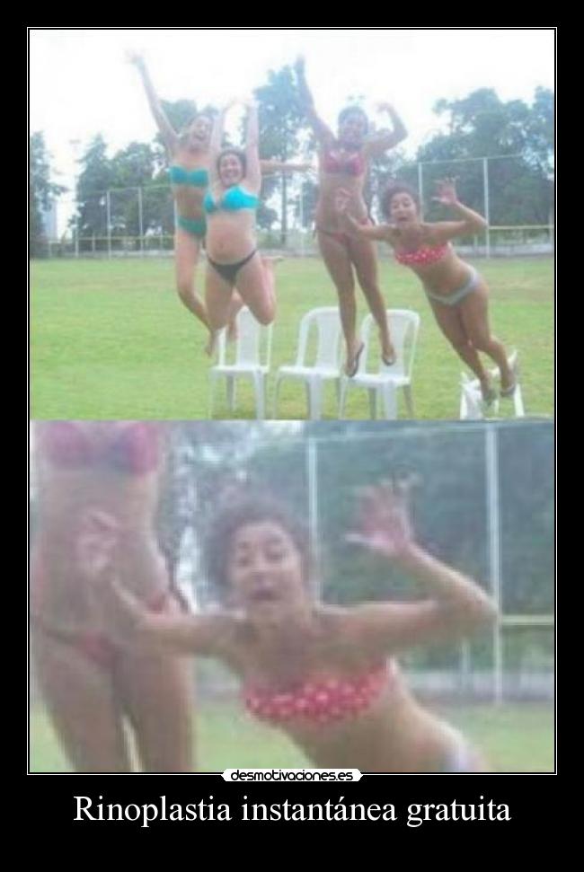 Rinoplastia instantánea gratuita - 