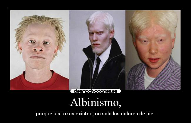 Albinismo, - porque las razas existen, no solo los colores de piel.