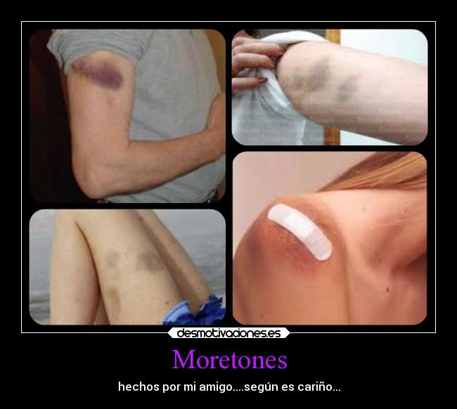 Moretones - hechos por mi amigo....según es cariño...