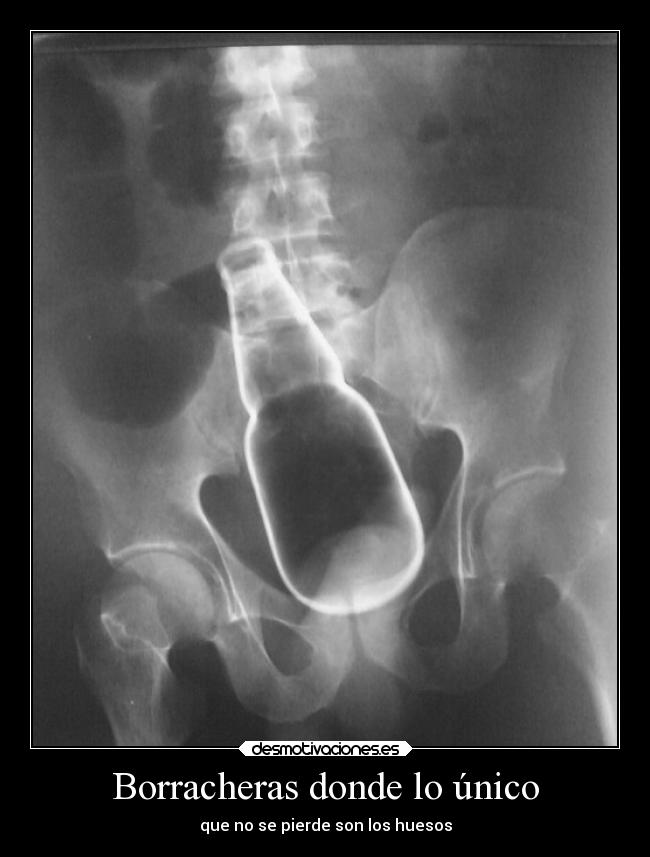 Borracheras donde lo único - que no se pierde son los huesos