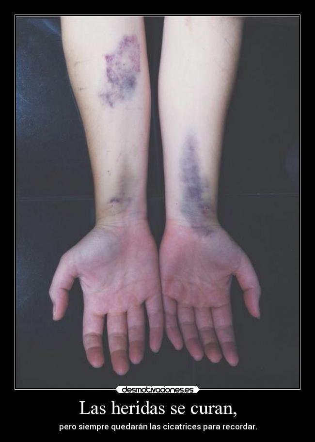 Las heridas se curan, -