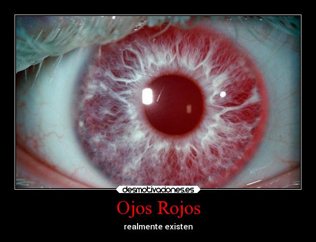 carteles ausencia melanina albinismo albino ojos rojos iris feel like beyond birthday desmotivaciones
