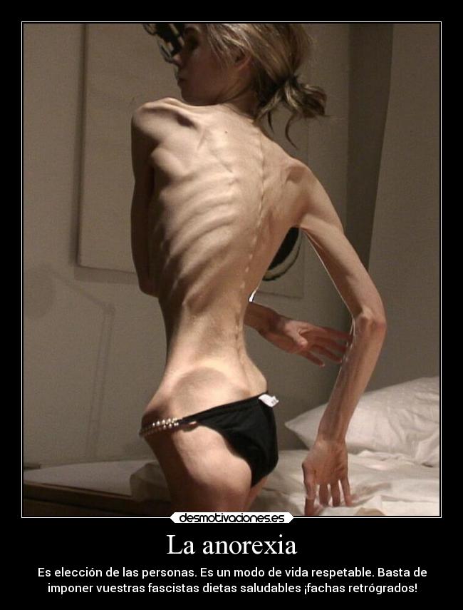 La anorexia - 