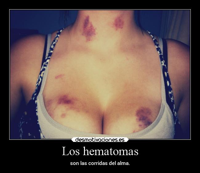 Los hematomas -