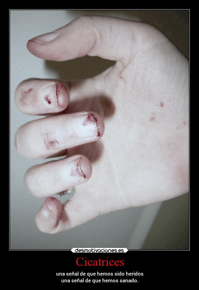 Cicatrices - una señal de que hemos sido heridos
una señal de que hemos sanado.