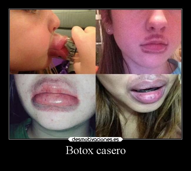 Botox casero -