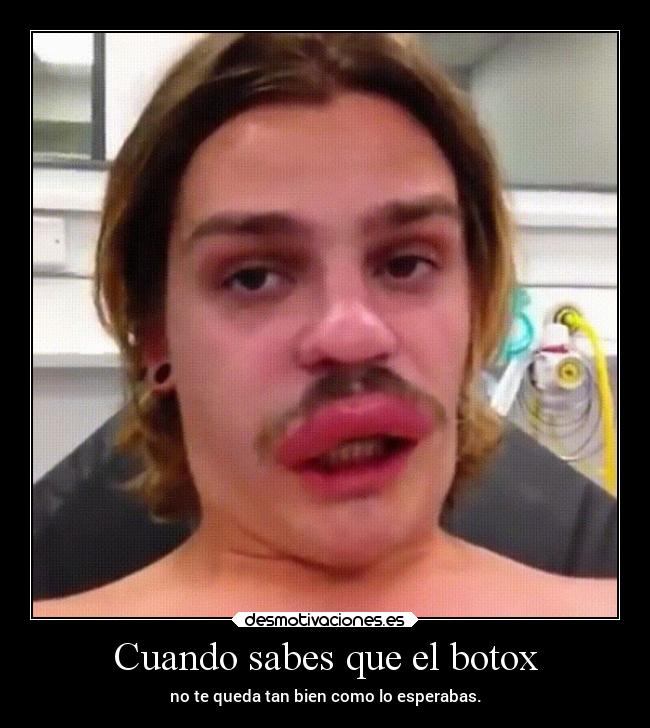 Cuando sabes que el botox - no te queda tan bien como lo esperabas.