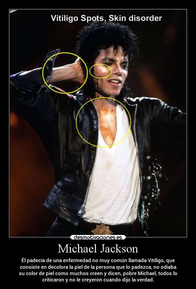Michael Jackson - Él padecía de una enfermedad no muy común llamada Vitíligo, que
consiste en decolora la piel de la persona que lo padezca, no odiaba
su color de piel como muchos creen y dicen, pobre Michael, todos lo
criticaron y no le creyeron cuando dijo la verdad.