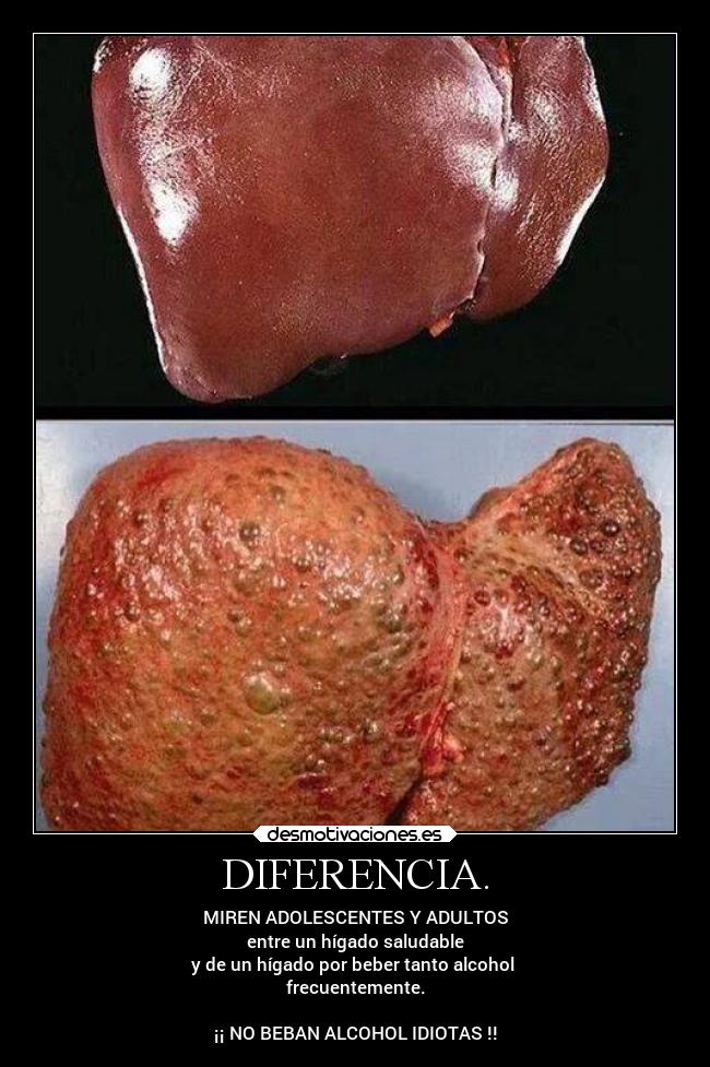 DIFERENCIA. - MIREN ADOLESCENTES Y ADULTOS
entre un hígado saludable
y de un hígado por beber tanto alcohol
frecuentemente.
¡¡ NO BEBAN ALCOHOL IDIOTAS !!