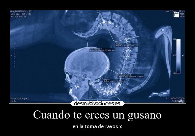 Cuando te crees un gusano - en la toma de rayos x