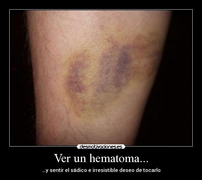 que es un hematoma